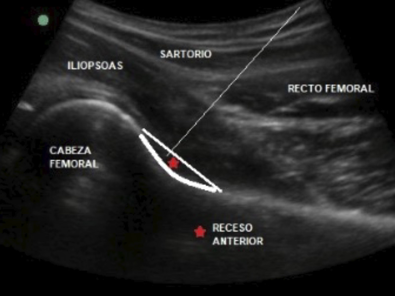 Ultrasound guided Hip Infiltration Drjordijimenez ultrasound-guided-hip-infiltration-drjordijimenez